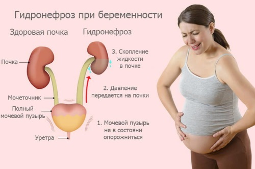 Беременность и гидронефроз 