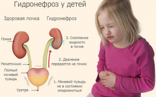 Гидронефроз у ребенка